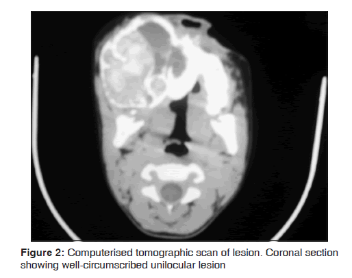 annals-medical-health-sciences-well-circumscribed