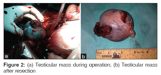 annals-medical-health-Testicular-mass