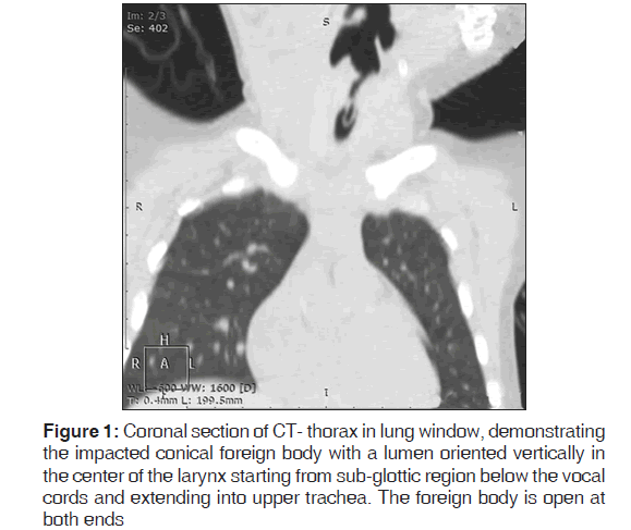 annals-medical-health-sciences-Coronal-section-CT-thorax-lung-window