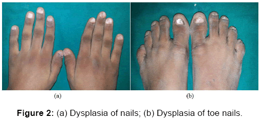 annals-medical-health-sciences-Dysplasia-nails