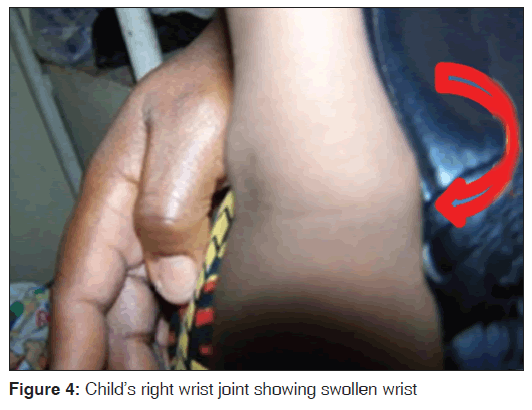 annals-medical-health-sciences-right-wrist-joint-swollen-wrist